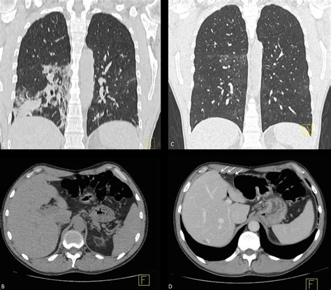 Ct Scans Performed For The Lung Evaluation A First Lung Ct Coronal