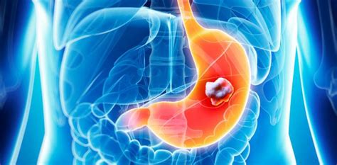 Fda Approves New Treatment For Certain Digestive Tract Cancers