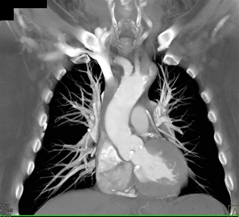 Aortic Valve Calcification And Endovascular Stents In Abdominal Aorta