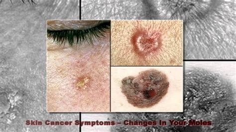 Skin Cancer Moles Review Youtube