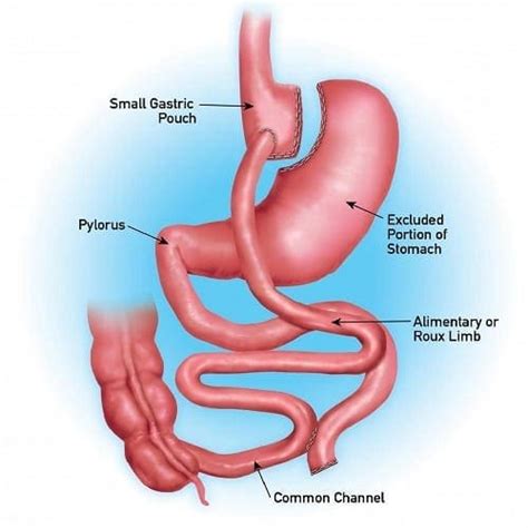 Gastric Bypass Revision Find Surgical And Non Surgical Weight Loss Journeylite