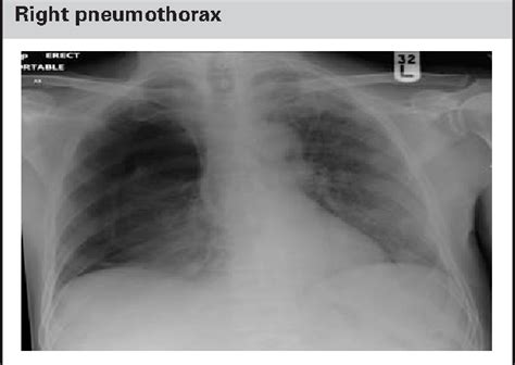 Figure 3 From Pneumothorax After Nasogastric Tube Insertion Semantic