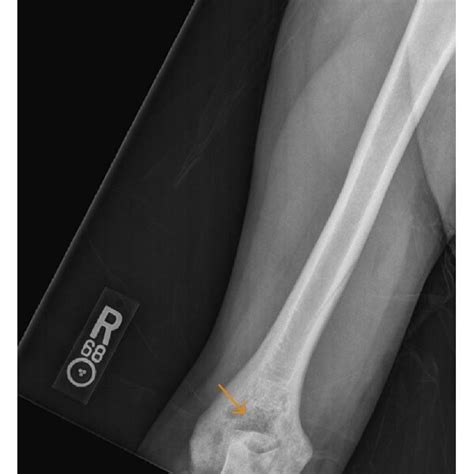 A 35 Year Old Male With Frontal Radiograph Of The Distal Right Humerus