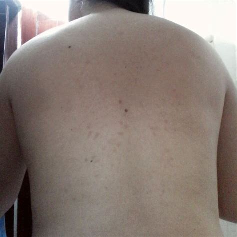 Pequenas Manchas Oscuras En La Espalda Y Hombro Dermatologo Net My