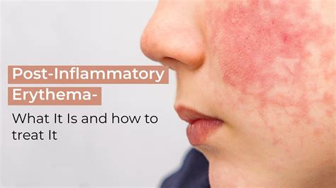Post Inflammatory Erythema What It Is And How To Treat It Suganda