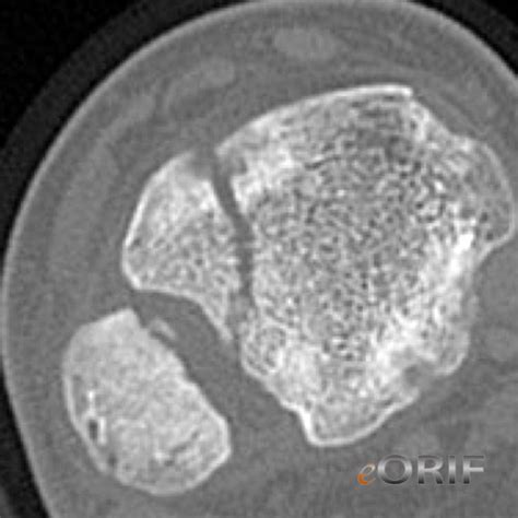 Tillaux Fracture S89.129A 823.80 | eORIF