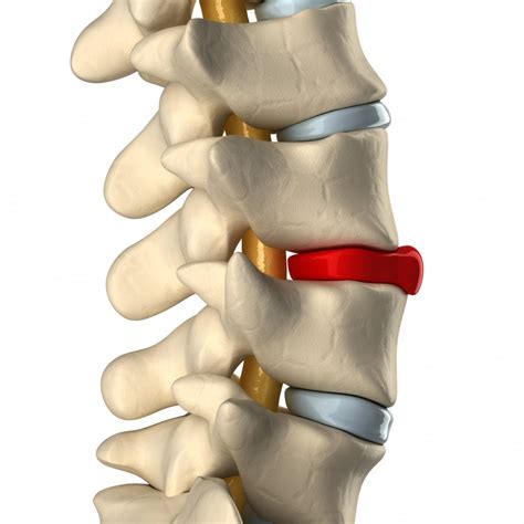 Whats The Difference Between A Herniated Disc And A Bulging Disc