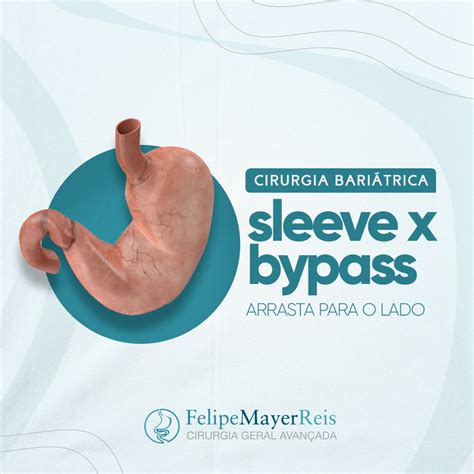 Cirurgia BariÁtrica Sleeve X Bypass Dr Felipe Mayer