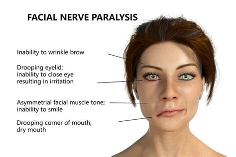 Bells Palsy Natural Treatment Overland Park Acupuncturist