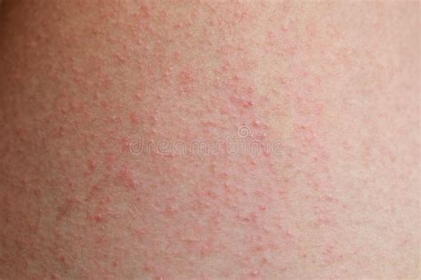 Eruzione Allergica Rossa Sulla Pelle Della Pancia Dermatite Atopica