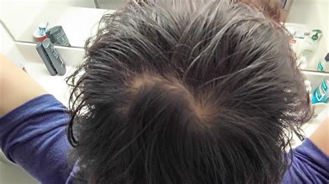 21 M Not Sure If Thinning Crown Or Tressless