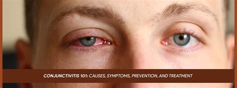 Conjunctivitis 101 Causes Symptoms Prevention And Treatment