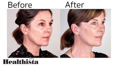 Non Surgical Facelift With Ultherapy Youtube