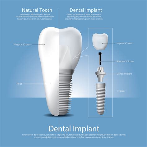 Human Teeth And Dental Implant Vector Illustration 570856 Vector Art At