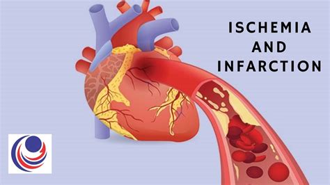 Ischemia And Infarction The Difference And Similarities Youtube