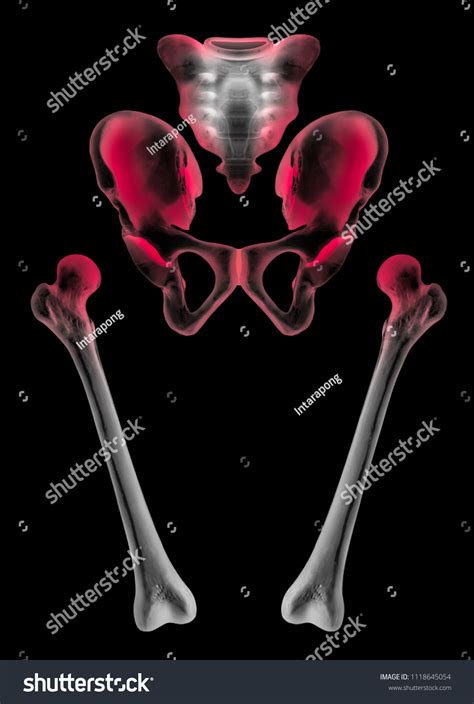 Xray Separate Human Hip Femur Bone Stock Illustration 1118645054