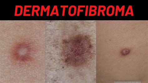 Dermatofibroma Causes Symptoms What Is It How Is It Treated Benign