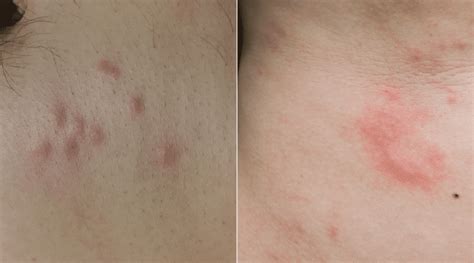 Bed Bugs Vs Hives How To Tell If Its Just A Bite Or An Allergic Reaction