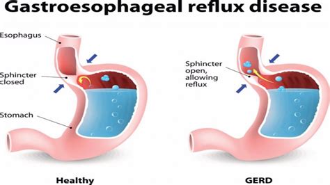 Reflux Esophagitis Dr Salunkhe
