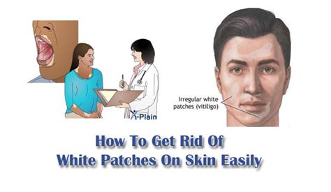 How To Get Rid Of White Patches On Skin Easily