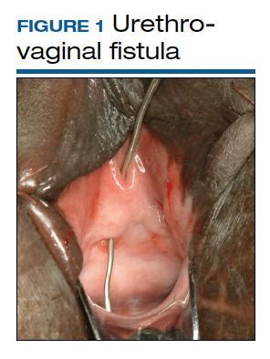 Vesicovaginal And Rectovaginal Fistulas From Obstetric Related Causes