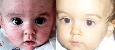 Before After Eczema Natural Eco Friendly Skincare Natural Eczema