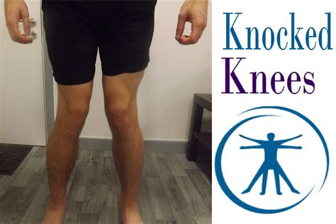 How To Fix Knocked Knees Genu Valgum With Correction Exercises And
