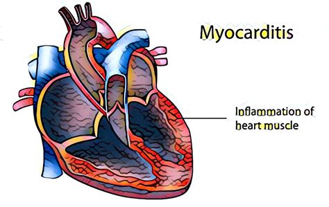 .терапии (myocarditis treatment trial) не удалось подтвердить гипотезу о преимуществе diagnosis of myocarditis: Myocarditis: Symptoms Causes, Possible Complications, And ...