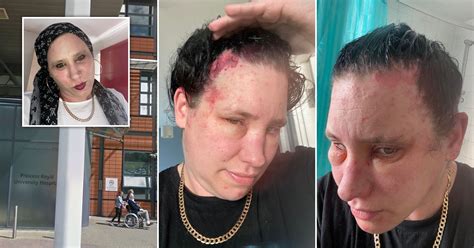Grans Head Ballooned And Skin Erupted In Rash After Severe Hair Dye