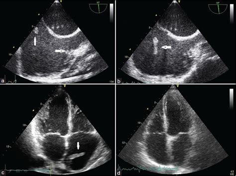 In this video, we can note the progression of acute myocarditis over time: Two cases of acute myocarditis with multiple intracardiac ...