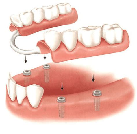 Mini Dental Implant Supported Denture 8 Images Implant Supported