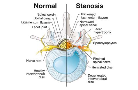 Lumbar Stenosis Causes Symptoms And Treatment Options For Narrowing Of The Spinal Canal And