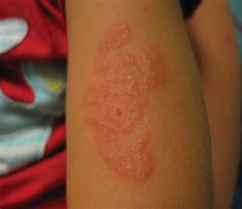 Photograph Of Patients Papulovesicular Lesion Which Was In The Shape