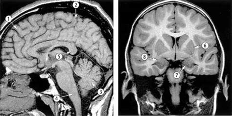 Anatomical Brain Defects A Multiple Anatomical Abnormalities Human Brain