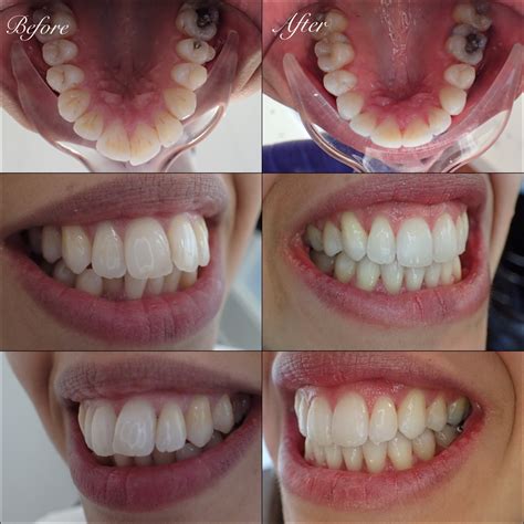 Adult Braces Exeter The Whyte House Dental Practice Exeter