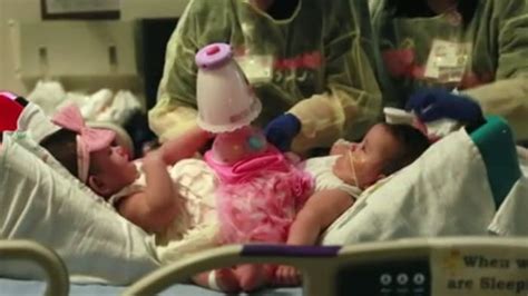 Video Conjoined Sisters Undergo Rare Separation Surgery