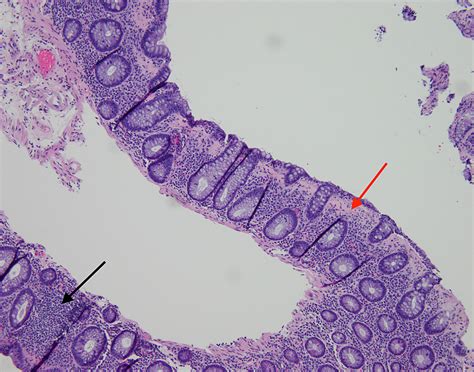 Cureus Cannabidiol Oil Associated Microscopic Colitis