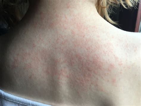 Maybe you would like to learn more about one of these? Does this look like an allergy rash? | Mumsnet