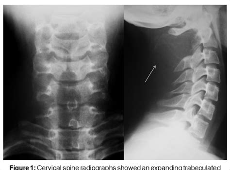 Figure 1 From Aneurysmal Bone Cyst Of The Upper Cervical Spine In A