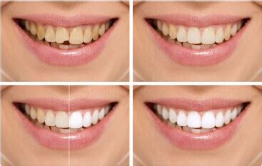 Is hydrogen peroxide swishing safe to whiten teeth there are a couple things to consider. How to Whiten Teeth with Hydrogen Peroxide ...