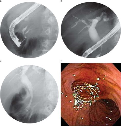 Endoscopic Retrograde Cholangiopancreatography Ercp Images Obtained
