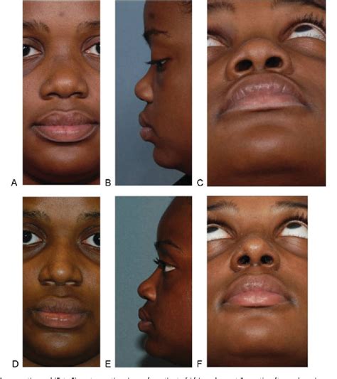 Figure 6 From Tip Nuances For The Nose Of African Descent Semantic