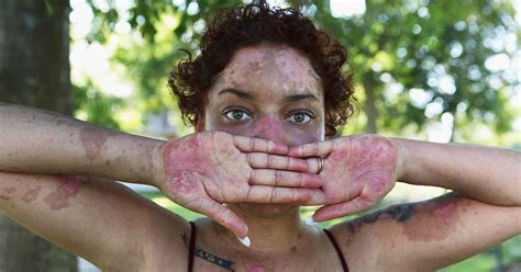 Inflammation caused by lupus can affect many different body systems. What is lupus: Treatment, symptoms and causes - TODAY