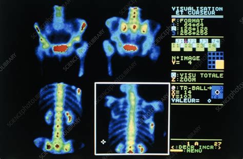Gamma Camera Scans Of Person Suffering Bone Cancer Stock Image M134