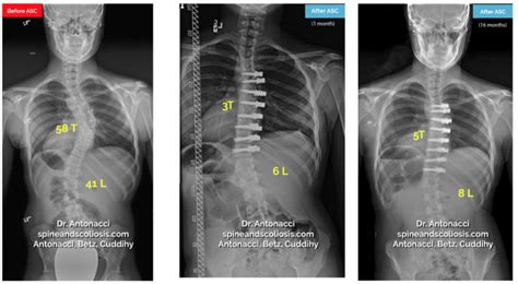 Scoliosis Surgery Before And After