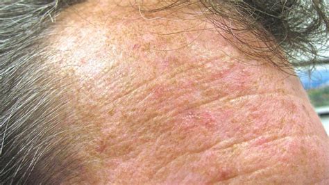 Actinic Keratosis Pictures Causes And Prevention