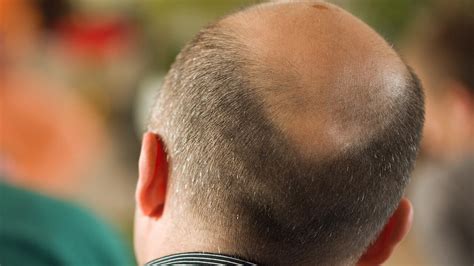 Hair Loss Treatment Dermatologist Professor Rodney Sinclair Develops