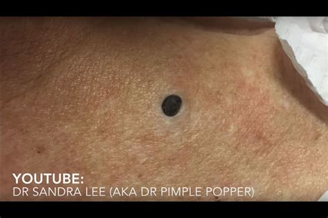 The Reason Why People Are Obsessed With Pimple Popping Videos