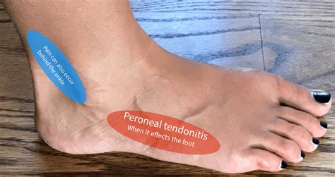 Peroneal Tendon Injuries Falls Church Ankle Instability Fairfax My
