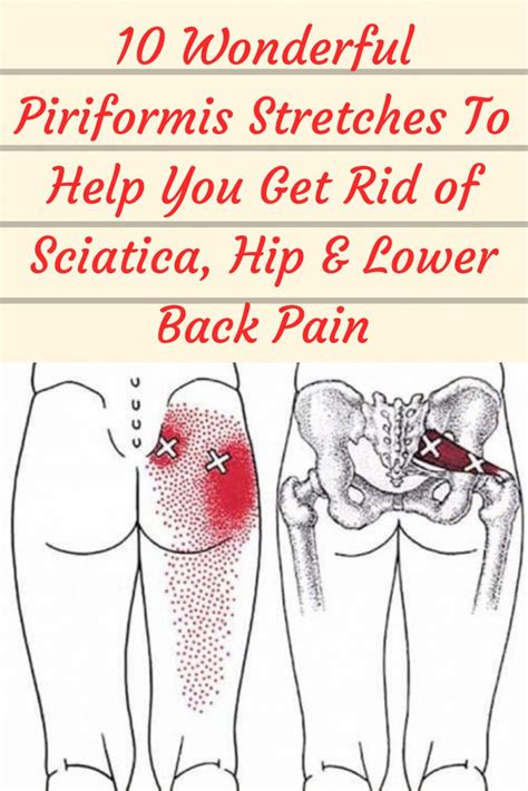 Pin On Back Pain Generalized